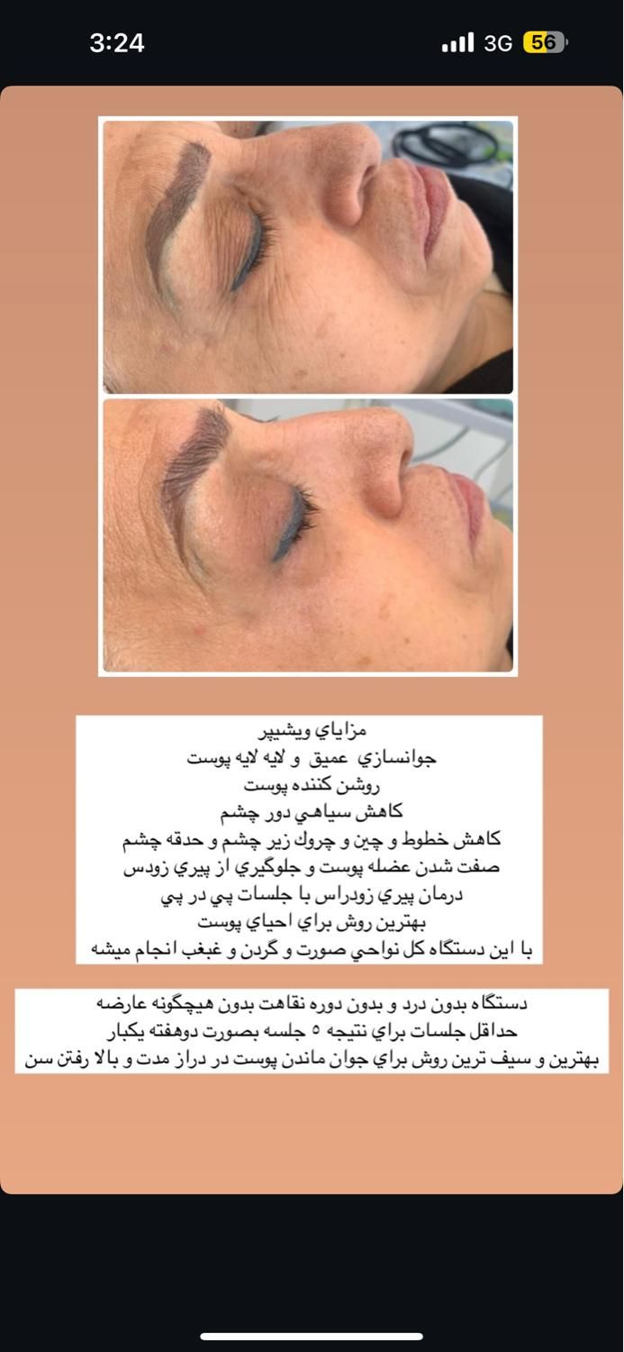 جوانسازی پوست و لیفت صورت|خدمات آرایشگری و زیبایی|تهران, زعفرانیه|دیوار