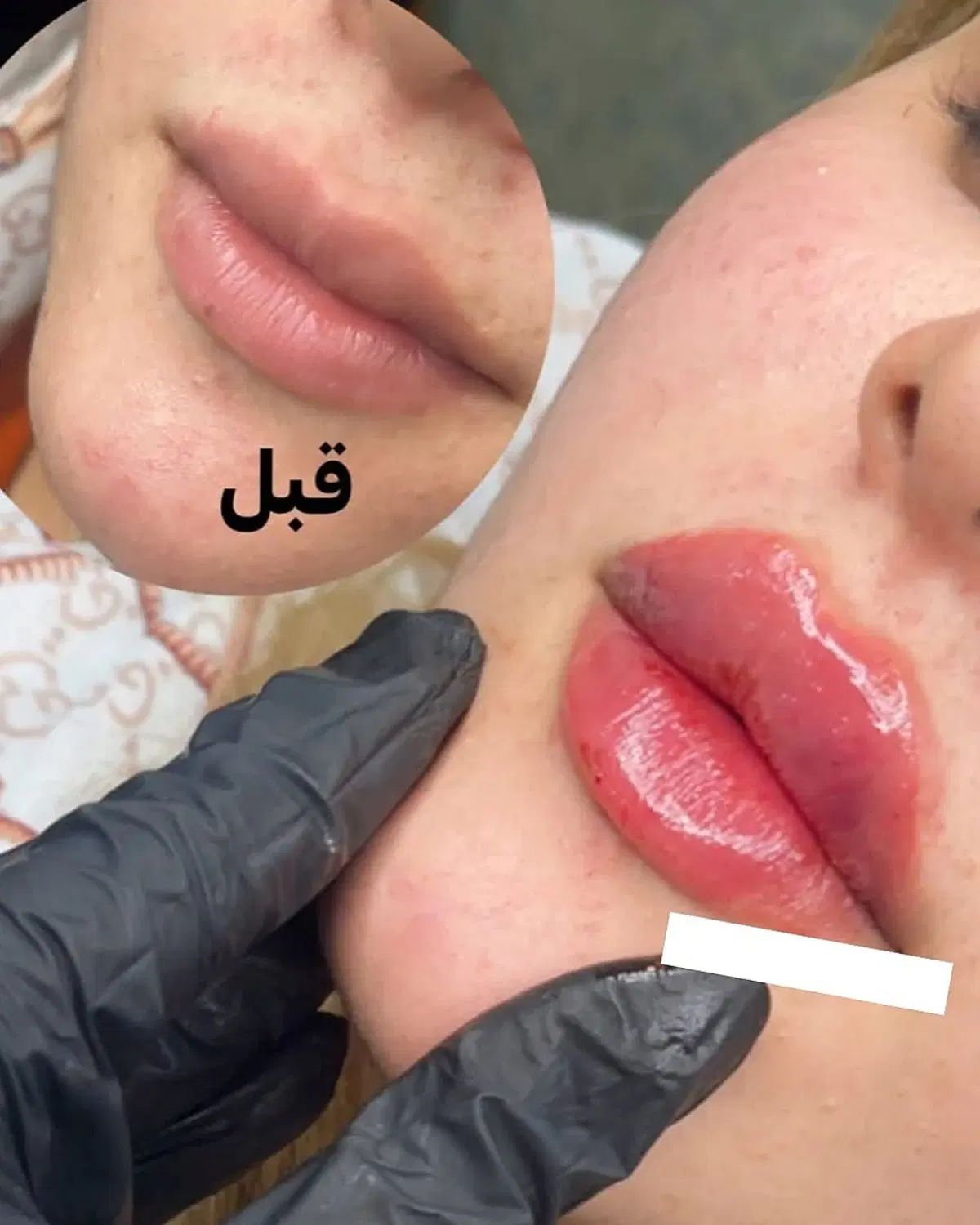 تزریق فیلر و بوتاکس(تخفیفمونو از دست نده)|خدمات آرایشگری و زیبایی|شهریار, شهرک وائین|دیوار