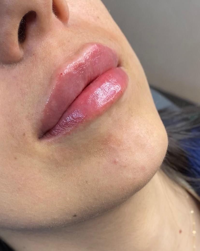 ژل لب متود روسی توسط پزشک حرفه ای|خدمات آرایشگری و زیبایی|حمیدیا, |دیوار