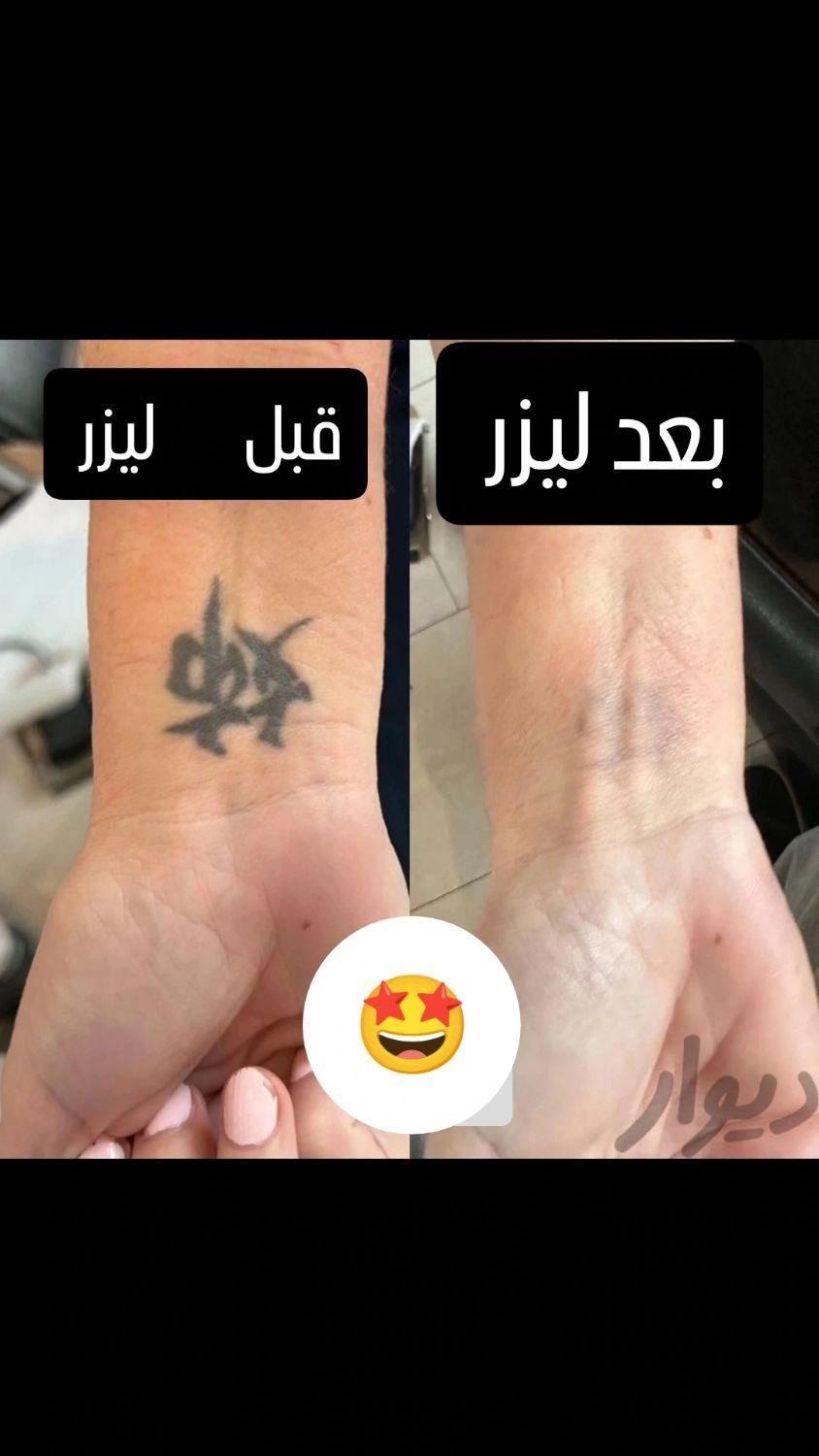 کلینیک تخصصی پاک کردن تتو با لیزر تضمینی/ریمو ابرو|خدمات آرایشگری و زیبایی|مشهد, کوثر|دیوار
