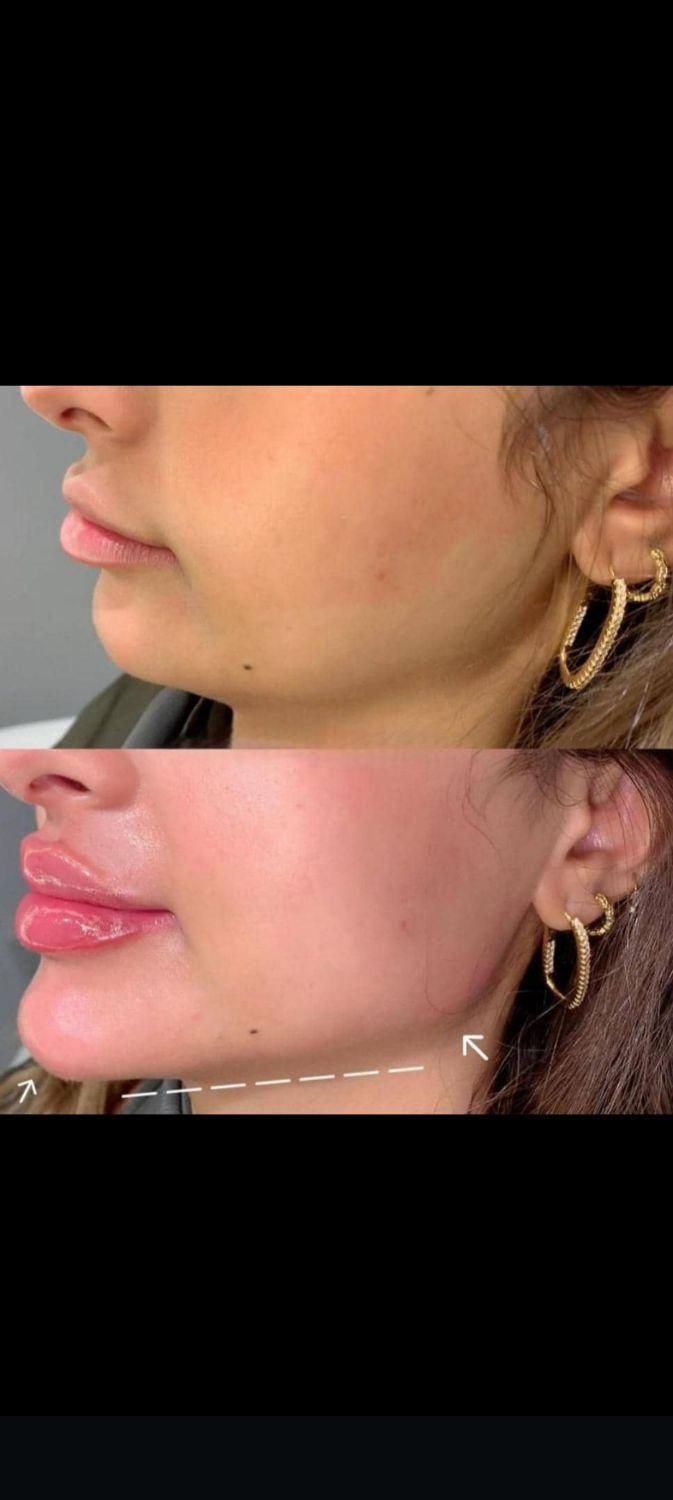 کاشت مو و کاشت ابرو وتزریق ژل و بوتاکس و مزو|خدمات آرایشگری و زیبایی|بهبهان, |دیوار