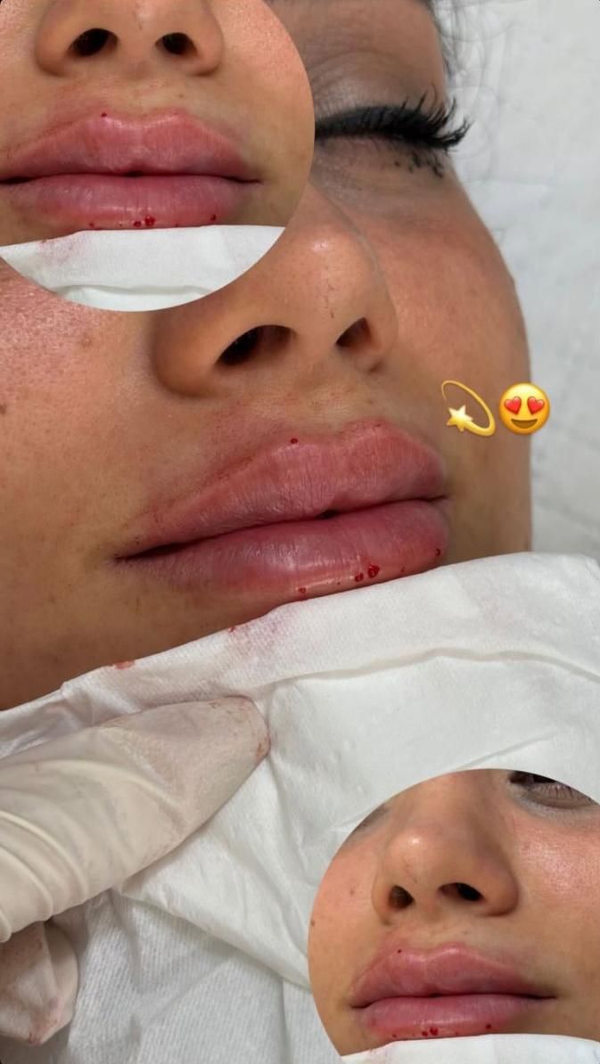 اف فیلرلب گونه چونه زاویه فقط 649|خدمات آرایشگری و زیبایی|محمدیه-قزوین, |دیوار
