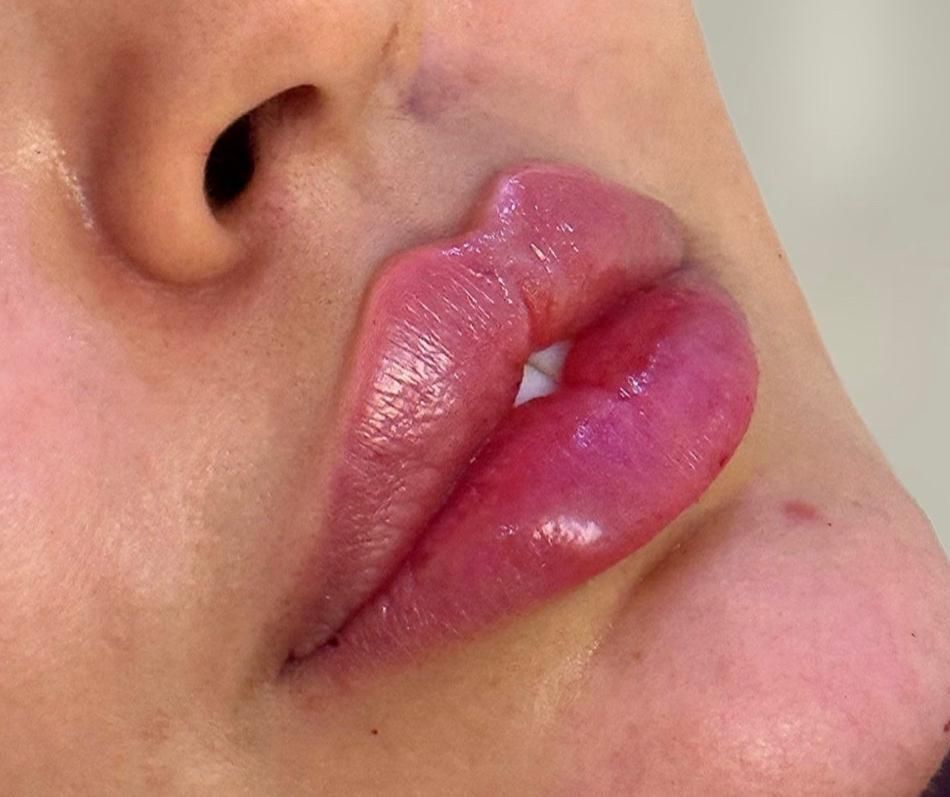 آموزش و تزریق ژل و بوتاکس|خدمات آرایشگری و زیبایی|اسلامشهر, شهرک سالور|دیوار