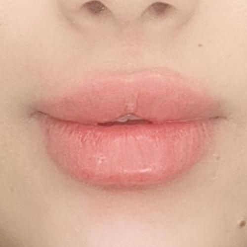 تزریق ژل و بوتاکس، لیزر موهای زائد، لاغری تضمینی|خدمات آرایشگری و زیبایی|رشت, دیلمان|دیوار