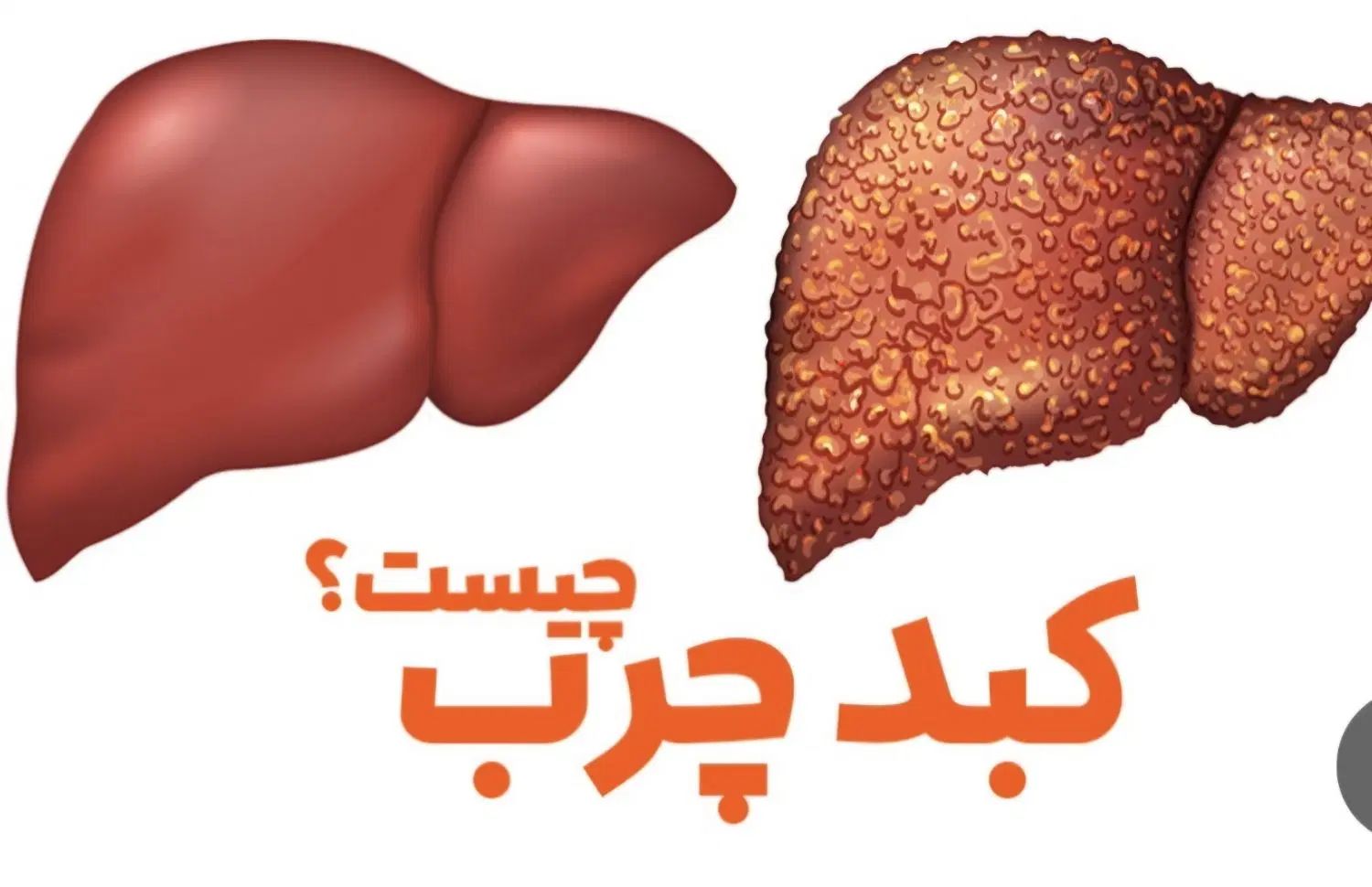 درمان کبد چرب|آرایشی، بهداشتی، درمانی|کرج, شهرک بهارستان|دیوار