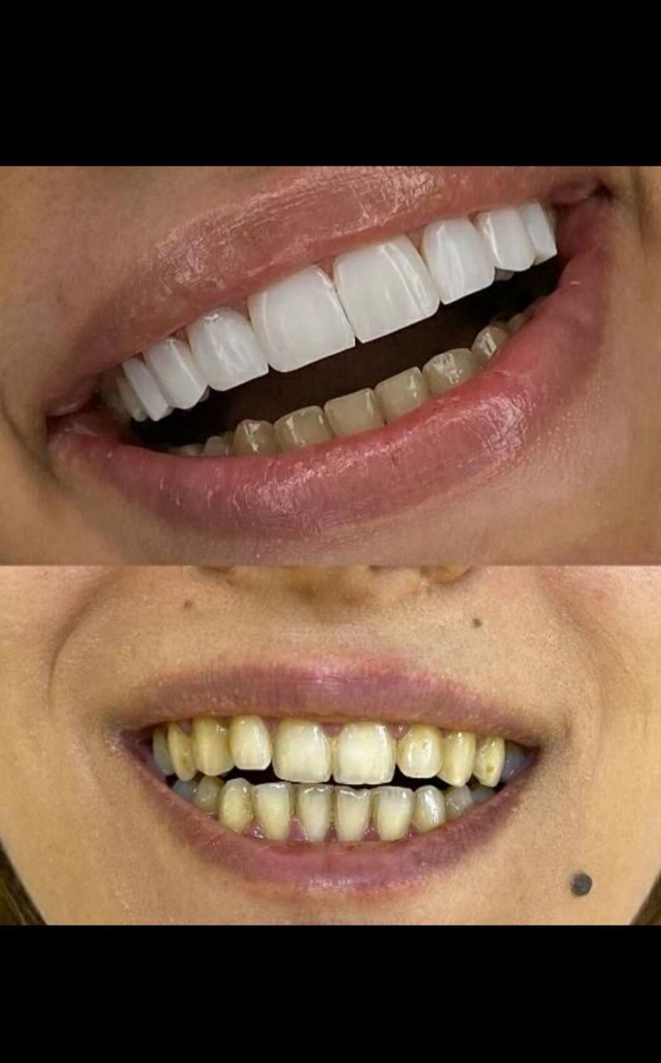 دندانپزشکی کامپوزیت لمینت|خدمات آرایشگری و زیبایی|قم, پردیسان|دیوار