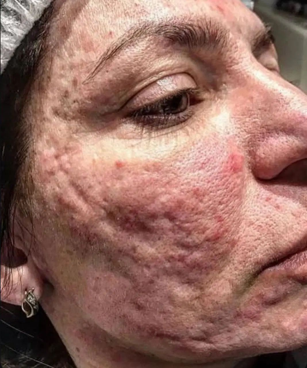 جشنواره تخفیف ویژه CO2 فرکشنال در کلینیک هُلو-کرج|خدمات آرایشگری و زیبایی|کرج, عظیمیه|دیوار