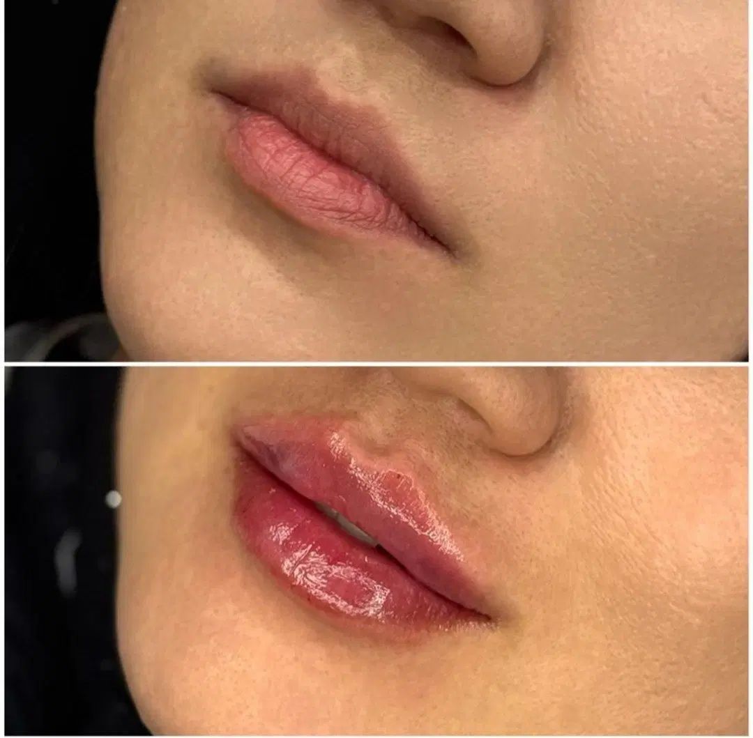 تخفیفات مدل ژل بوتاکس مزو،پاکسازی و جوانسازی صورت|خدمات آرایشگری و زیبایی|مشهد, طلاب|دیوار