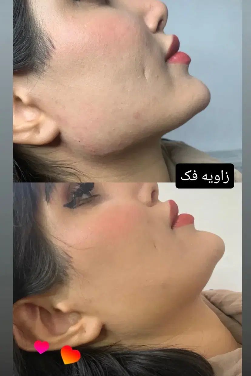 جشنواره ویژه فیلر لب فول فیس زاویه فک،گونه،چونه و.|خدمات آرایشگری و زیبایی|مشهد, شهید فرامرز عباسی|دیوار