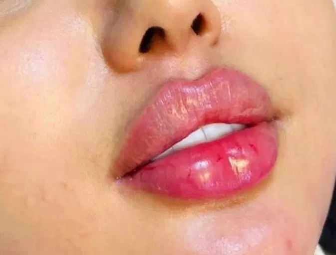 تزریق ژل لب فیلر زاویه سازی صورت فک گونه بوتاکس|خدمات آرایشگری و زیبایی|فردیس, خیام شرقی|دیوار