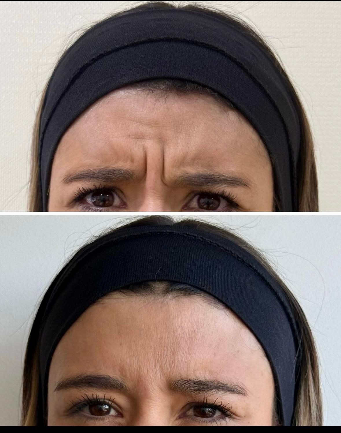 فقط امروز / بوتاکس  /بدون ماسکه شدن صورت/۶۵۰|خدمات آرایشگری و زیبایی|رشت, معلم|دیوار