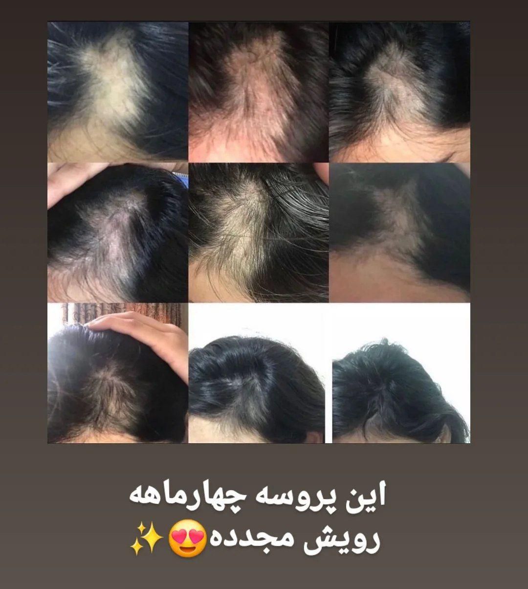 دفتر رسمی نمایندگی سرم سیر سیاه پرپشتی مو و ریش|آرایشی، بهداشتی، درمانی|مشهد, طبرسی شمالی|دیوار