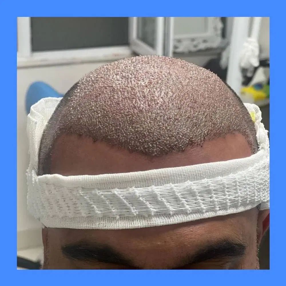 جشنواره کاشت تخصصی مو فول تراکم ۷ ملیون یک هفته|خدمات آرایشگری و زیبایی|تهران, ونک|دیوار