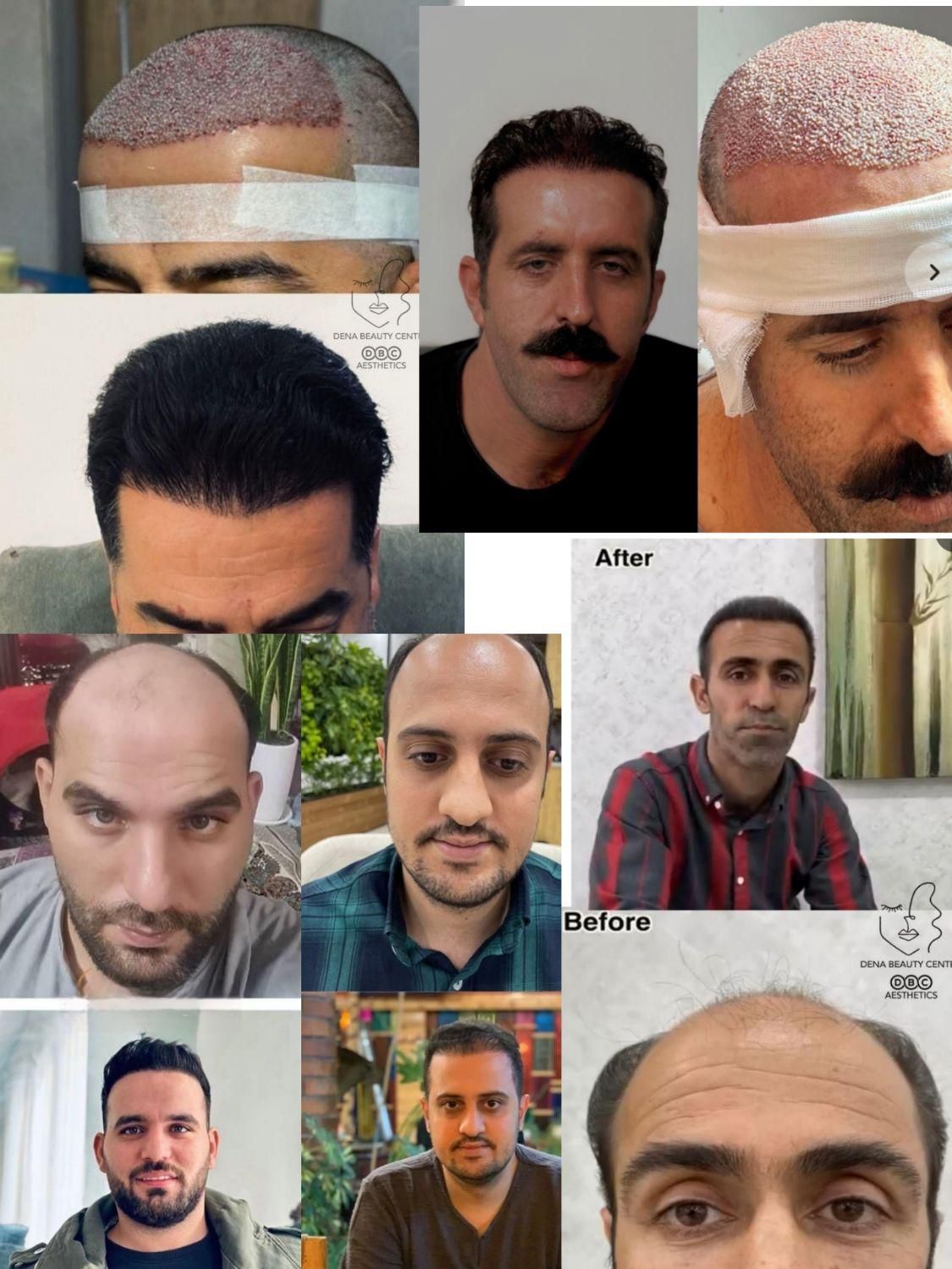 مرکزکاشت مو/ابرو دنا/تیم کاشت بین‌المللی(غیربومی)|خدمات آرایشگری و زیبایی|یاسوج, |دیوار