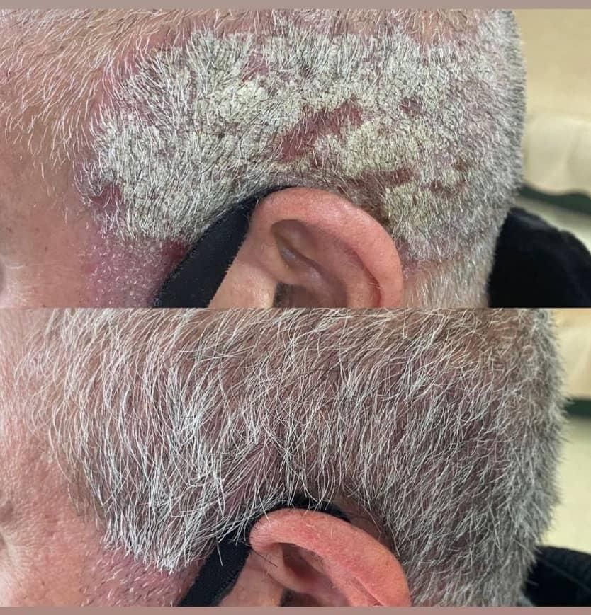 درمان تضمینی پیسی و پسوریازیس|خدمات آرایشگری و زیبایی|مشهد, انقلاب|دیوار