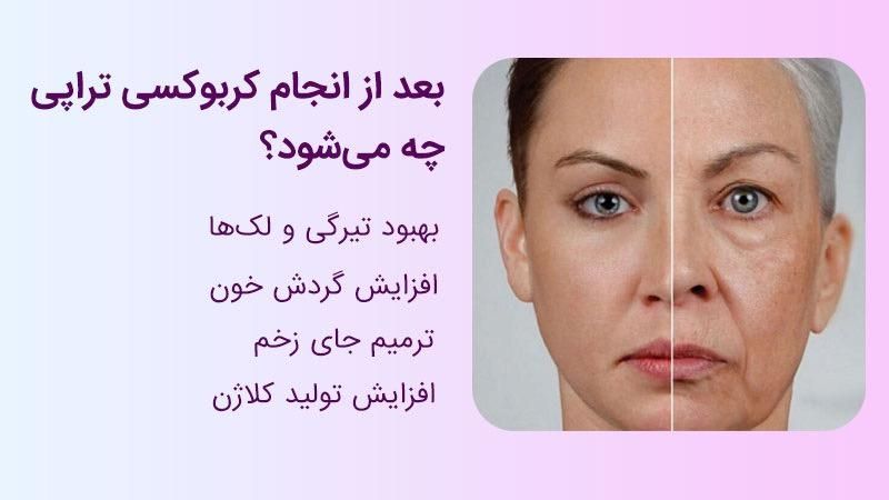 مدل کربوکسی تراپی صورت در کلینیک پوست فاز۲|خدمات آرایشگری و زیبایی|پردیس, فاز ۲|دیوار