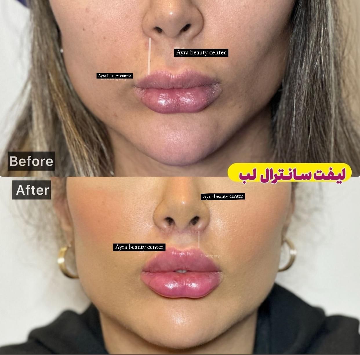 بلفاروپلاستی-سانترال لب-بوکال فت-ساکشن غبغب|خدمات آرایشگری و زیبایی|تهران, پاسداران|دیوار