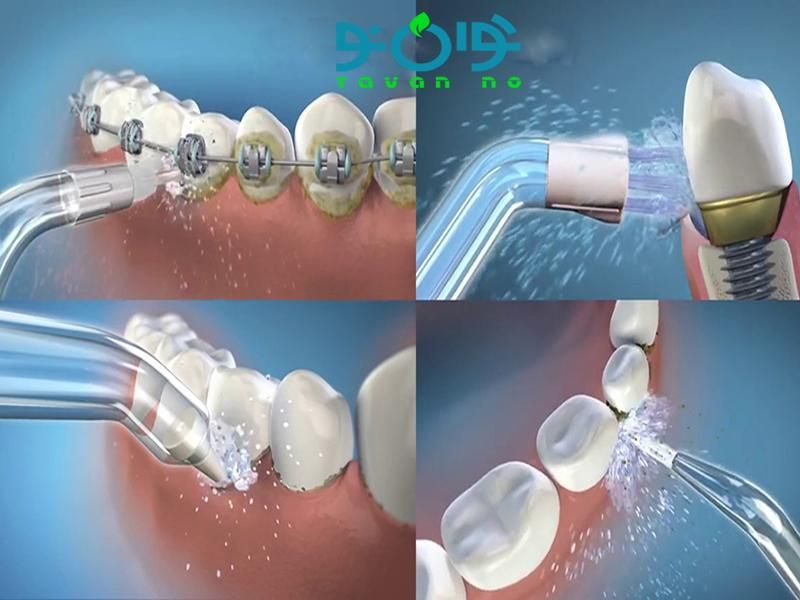 واترجت دندان شارژی ارتودنسی کامپوزیت ایمپلنت|آرایشی، بهداشتی، درمانی|تبریز, |دیوار