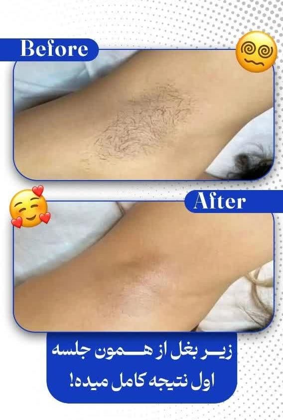 لیزر موج کندلا لیزر آقایان لیزر بانوان|خدمات آرایشگری و زیبایی|اصفهان, نقش جهان|دیوار
