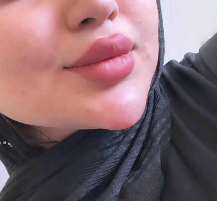 تزریق تخصصی ژل لب تزریق بادی لیفت نخ و چربی|خدمات آرایشگری و زیبایی|خرمشهر, |دیوار