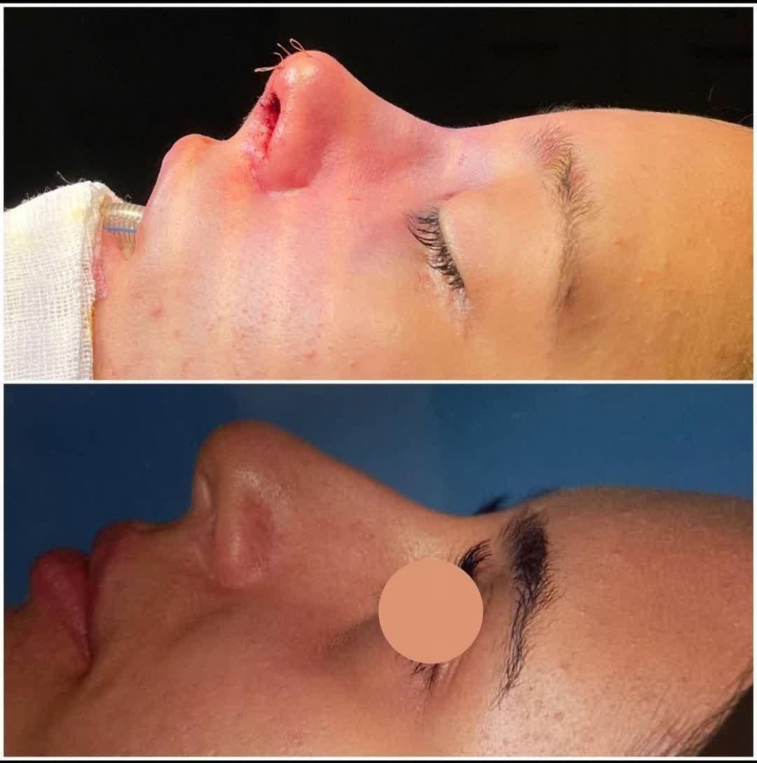 جراحی و عمل زیبایی بینی ( رینو پلاستی )|خدمات آرایشگری و زیبایی|کرج, گوهردشت|دیوار