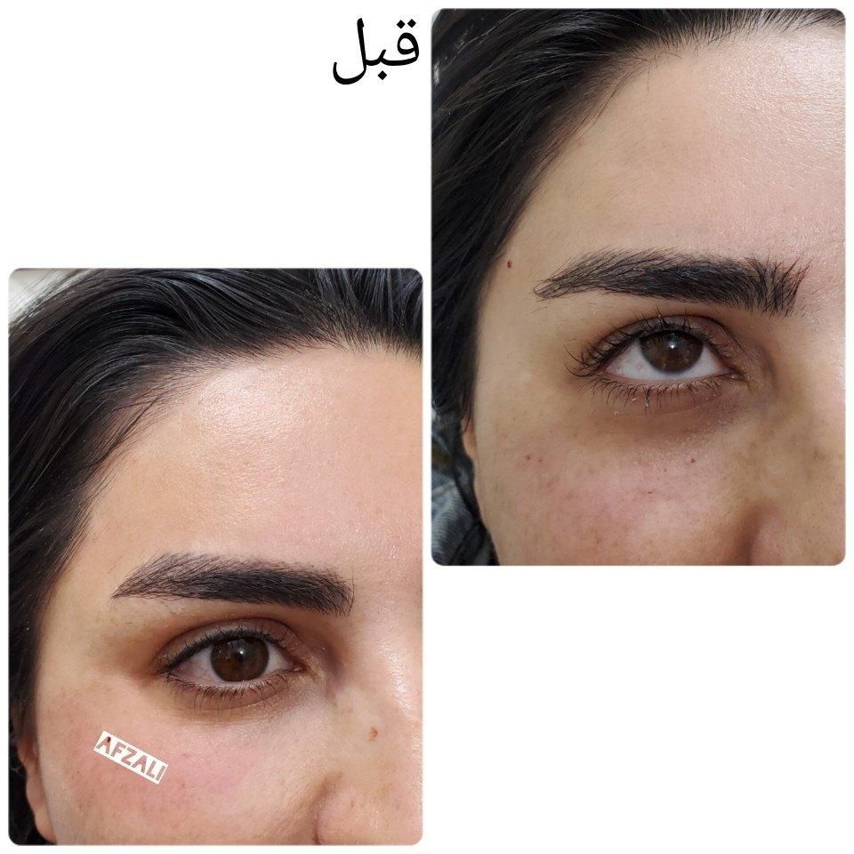 کاشت مو/لیزر مـو زائد/لاغری/فیلر بادی/ نخ و بوتاکس|خدمات آرایشگری و زیبایی|شیراز, گل سرخ|دیوار