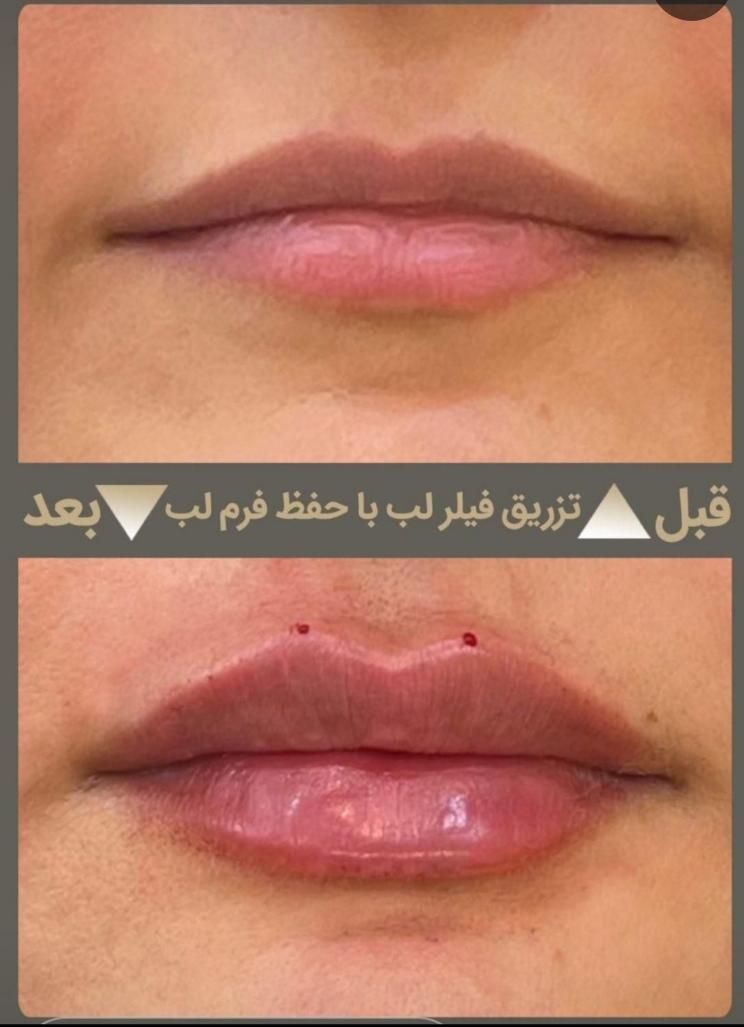 تزریق حرفه ای فیلر در کلینیک زیبایی و لیزر راویس|خدمات آرایشگری و زیبایی|کاشان, رجایی|دیوار