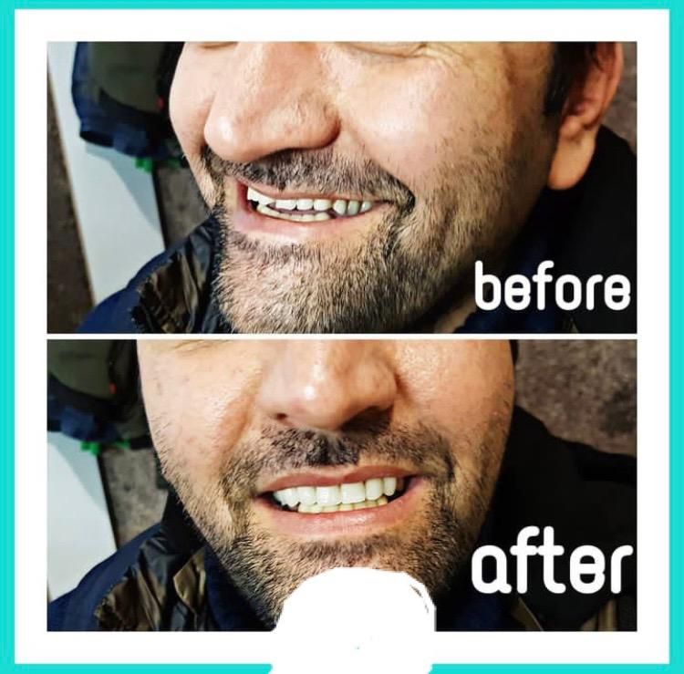 دندان مصنوعی لبخند (ضمانت ۱۰ ساله/تحویل ۳تا ۷ روز)|خدمات آرایشگری و زیبایی|کرج, اصفهانیها|دیوار