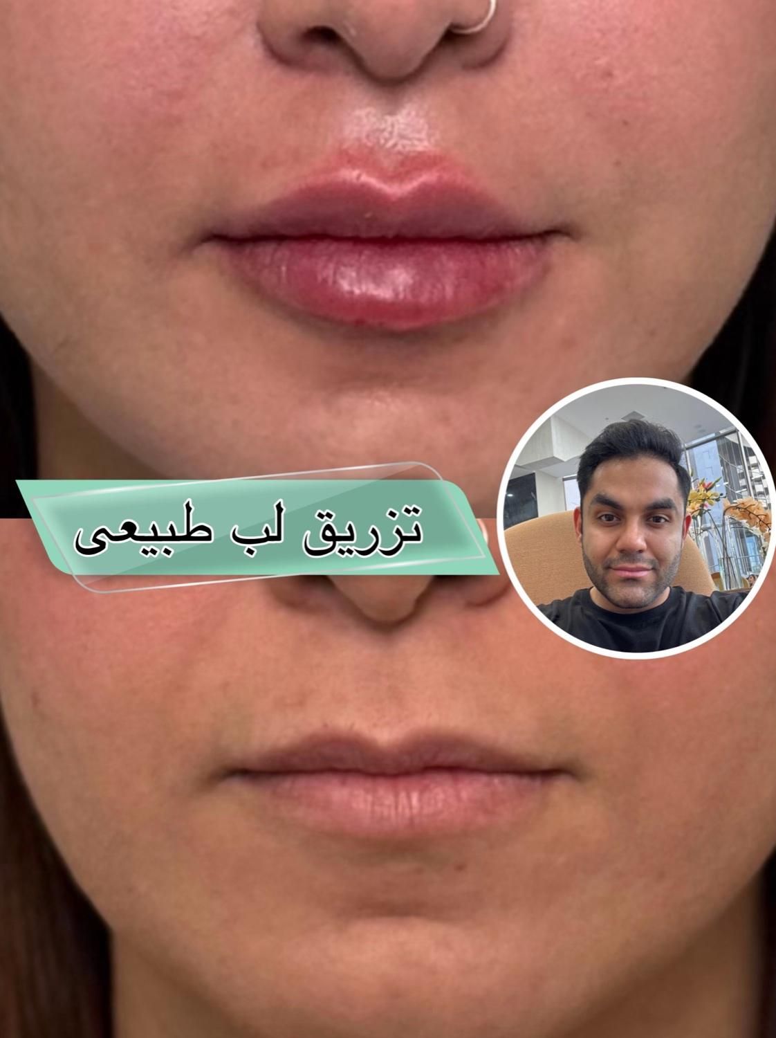 مدل برای تزریق فیلر لب توسط پزشک حرفه ای رایگان|خدمات آرایشگری و زیبایی|تهران, یوسف‌آباد|دیوار