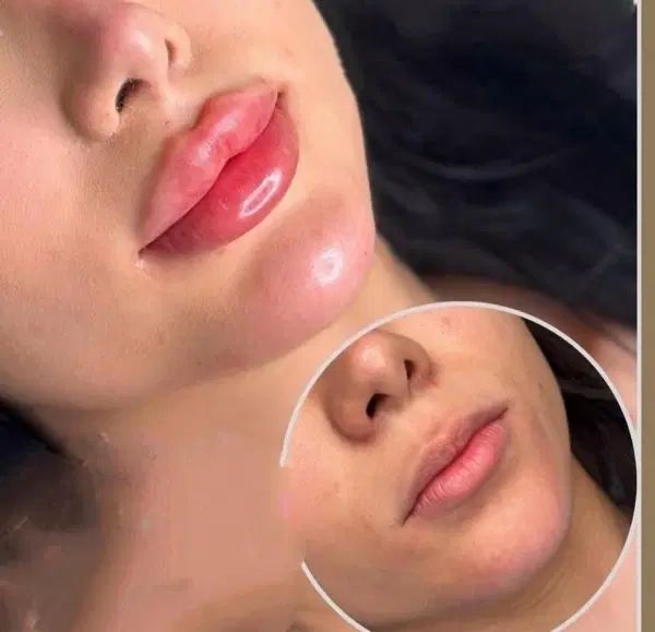 جشنواره تزریق ژل و بوتاکس در مطب با۴۰درصد تخفیف|خدمات آرایشگری و زیبایی|کرمانشاه, |دیوار