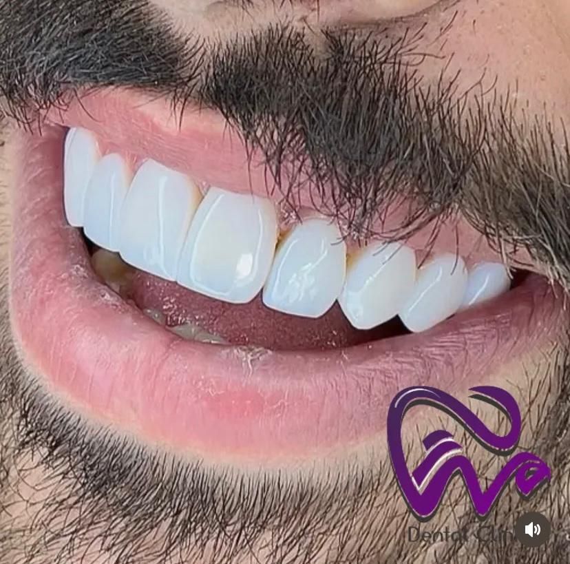 کامپوزیت دندان/لیرینگ/لمینت «اقساط»|خدمات آرایشگری و زیبایی|تهران, تجریش|دیوار