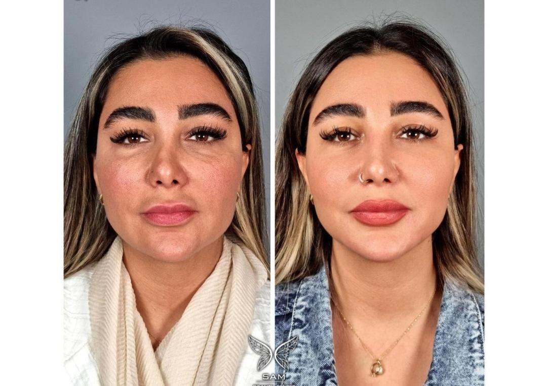 مدل جوانسازی و زیباسازی ولیفت صورت رفع چروک ولک|خدمات آرایشگری و زیبایی|رشت, لاکانی|دیوار