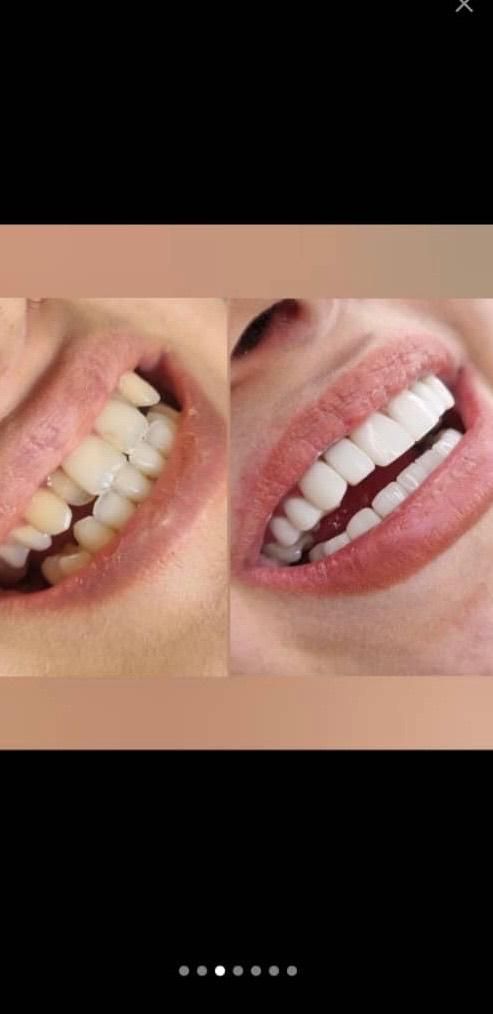 دندانپزشکی ستارخان اقساط ایمپلنت کامپوزیت عصبکشی|خدمات آرایشگری و زیبایی|تهران, صادقیه|دیوار