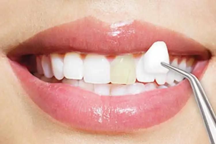 مدل برای انجام لمینت دندان|خدمات آرایشگری و زیبایی|تهران, فرمانیه|دیوار