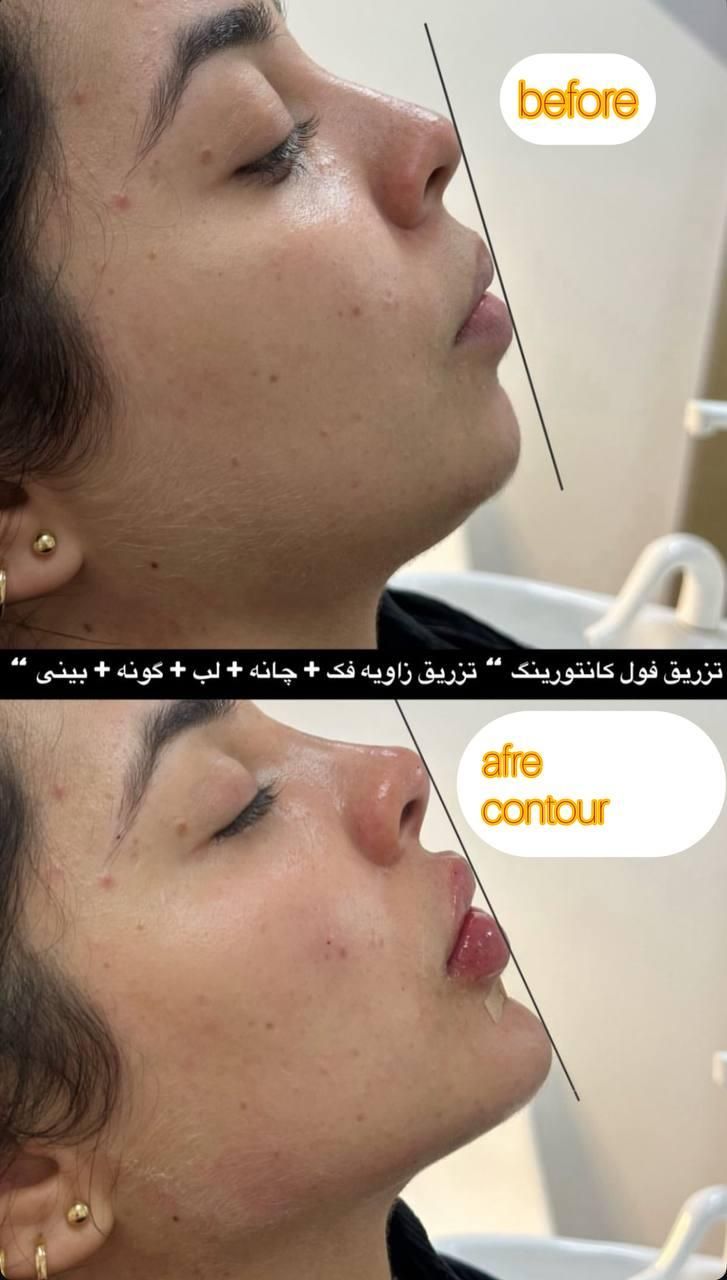 ژل و بوتاکس مرو فیلر توسط دکتر تخفیف ۳۰ ٪|خدمات آرایشگری و زیبایی|مشهد, کوثر|دیوار