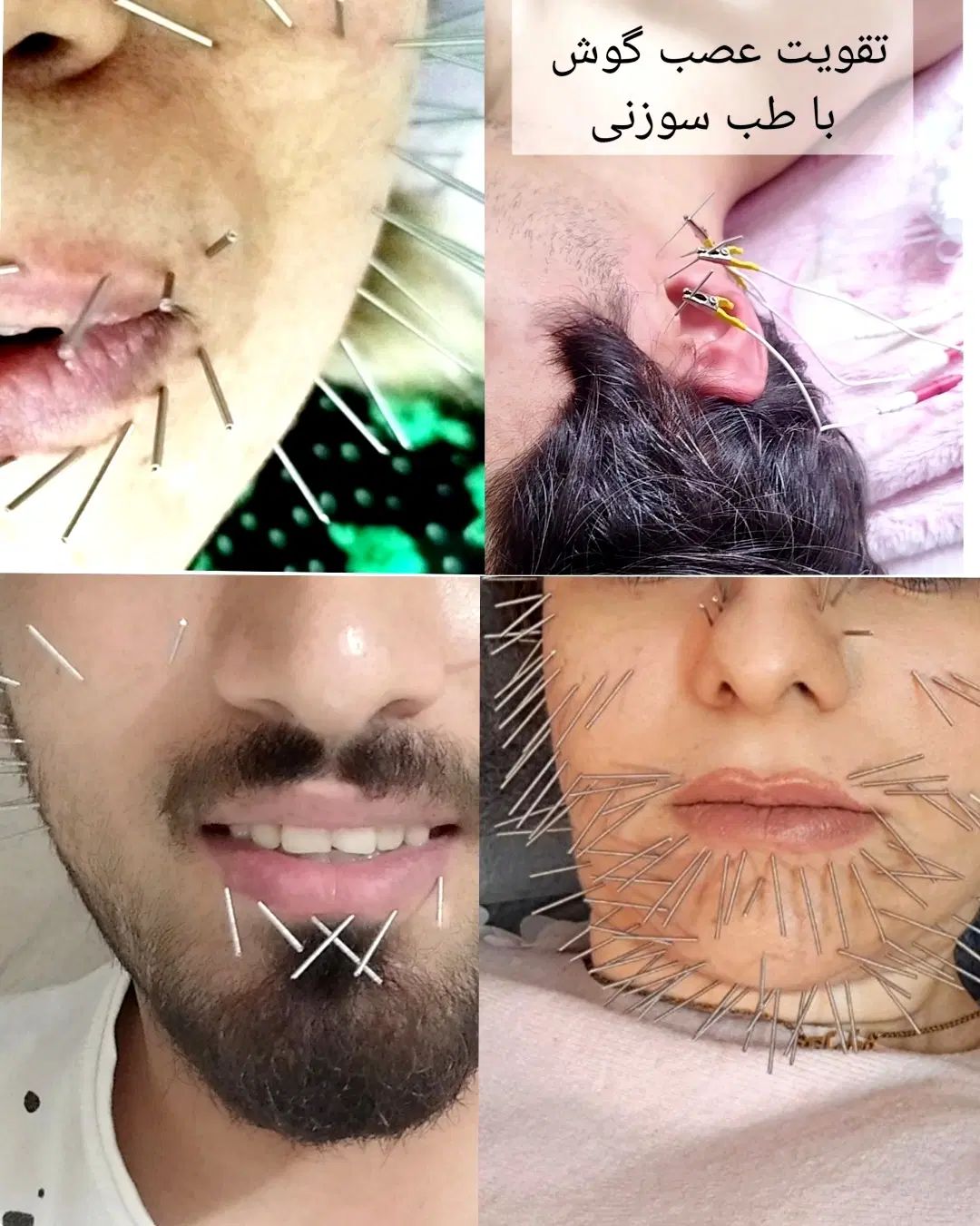 فیزیوتراپی طب سوزنی فصد حجامت زالو در منزل|خدمات آرایشگری و زیبایی|تهران, ایران|دیوار