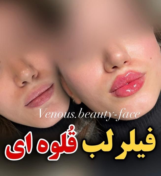 تزریق ژل لب روسی390بوتاکس/پروفایلو/مادلینگ/لیزر|خدمات آرایشگری و زیبایی|تهران, طرشت|دیوار