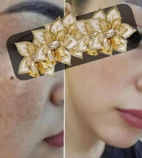 درمان سریع کک مک و لایه برداری پوست سفیده کننده|آرایشی، بهداشتی، درمانی|جیرفت, |دیوار