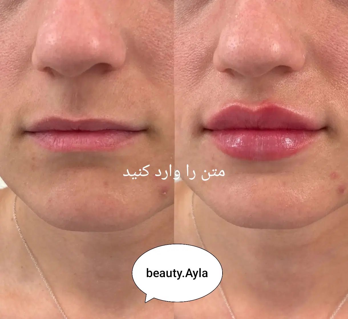 تزریق ژل و بوتاکس و مزو ( جوانسازی و روشن کننده)|خدمات آرایشگری و زیبایی|اهواز, گلستان|دیوار