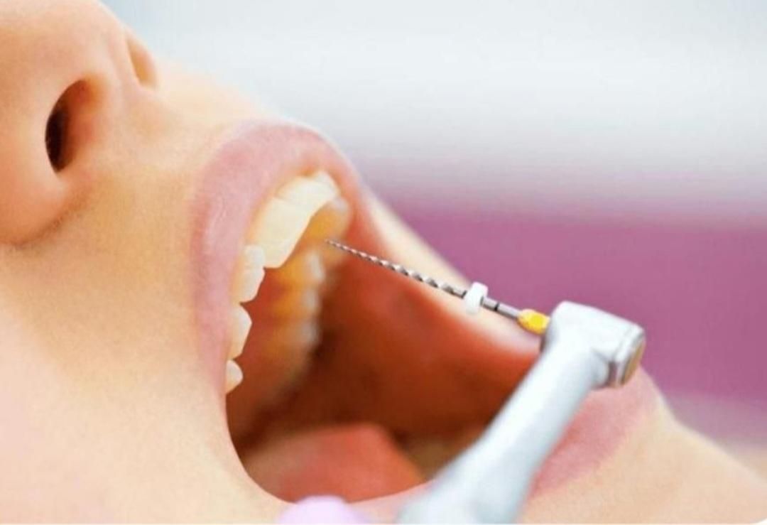 کامپوزیت. لمینت .عصب کشی .مروارید|خدمات آرایشگری و زیبایی|مشکین‌دشت, |دیوار
