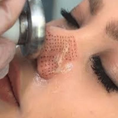 هایفو جوانسازی مزو فیشیال لاغری غبغب، مو|خدمات آرایشگری و زیبایی|اصفهان, شفق|دیوار
