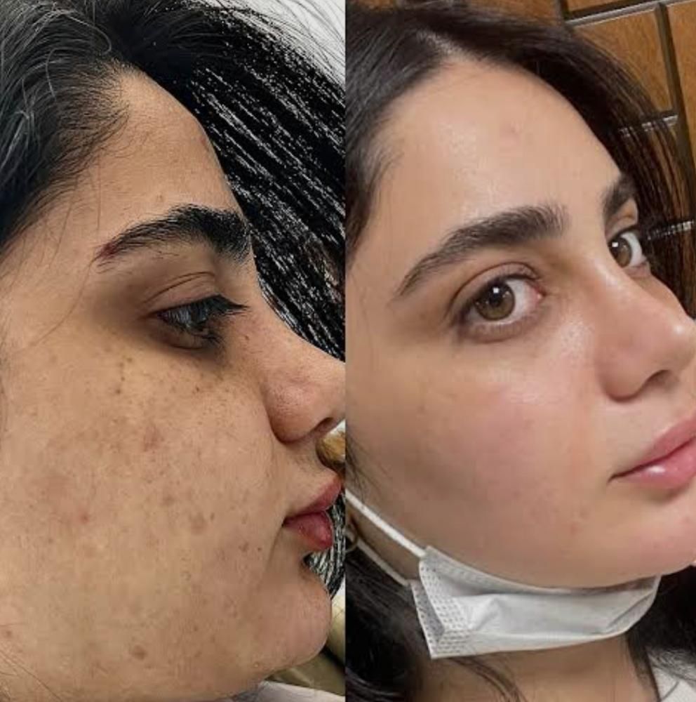 پاکسازی پوست صورت تخصصی (فیشیال vip)|خدمات آرایشگری و زیبایی|سنندج, |دیوار