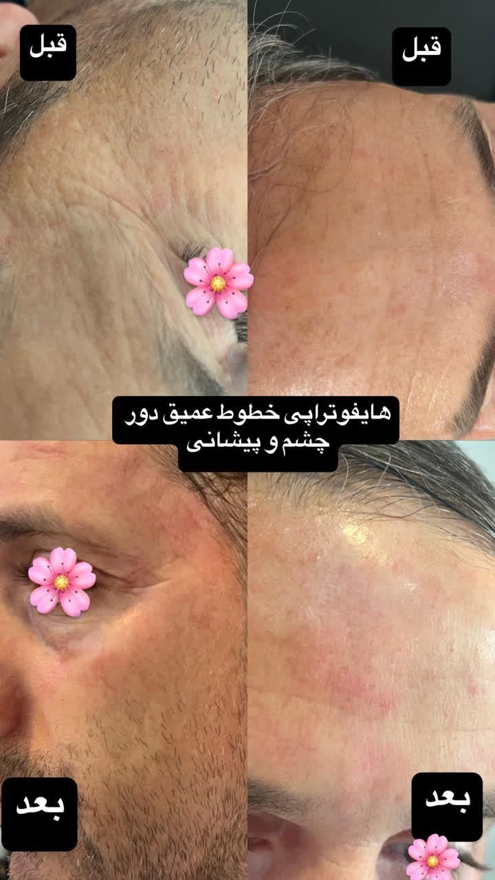 هایفوتراپی و آر اف|خدمات آرایشگری و زیبایی|قم, دورشهر|دیوار