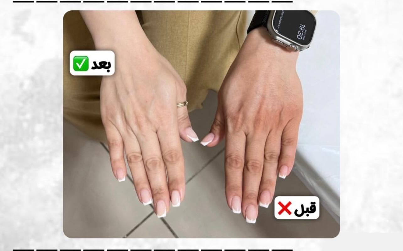 تخفیف لیزر اشنایدرپلاس و روشن سازی نواحی تیره|خدمات آرایشگری و زیبایی|بندرعباس, |دیوار