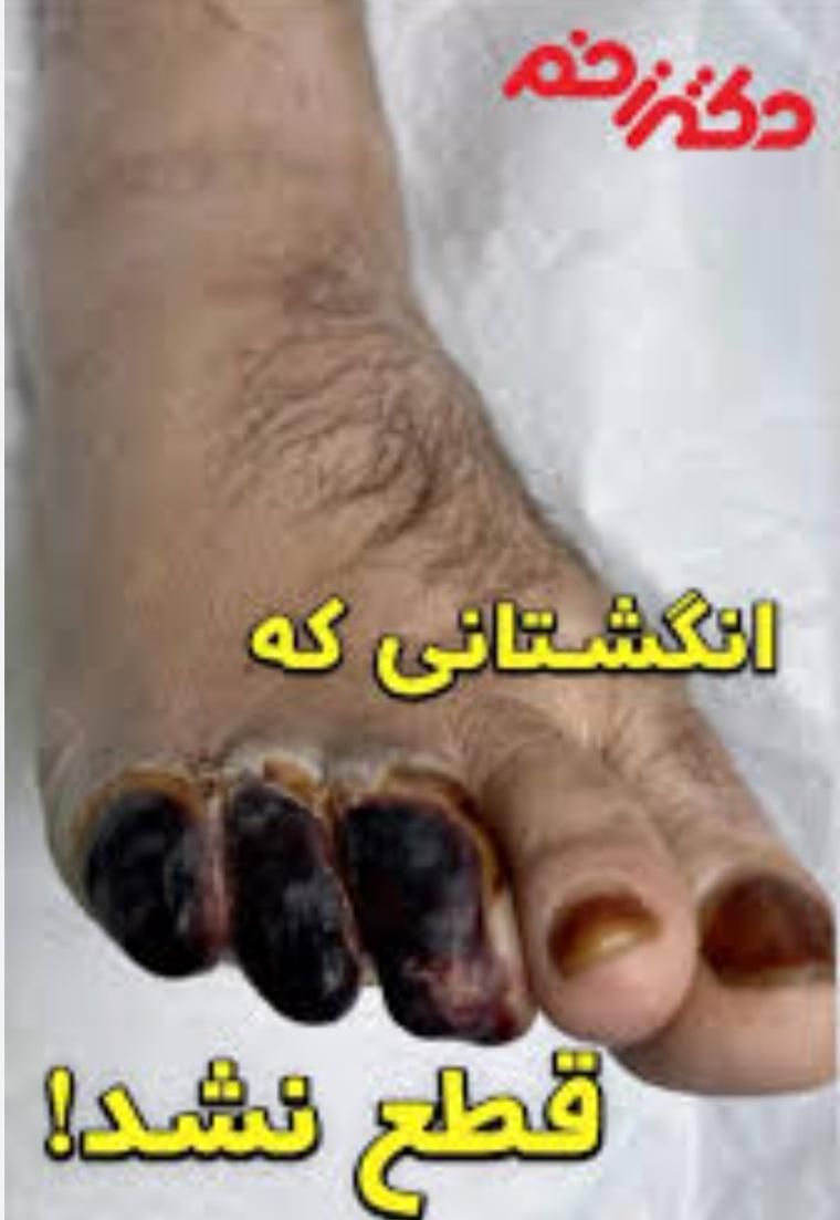 بهبودی کامل دیابت بدونه نیاز به قرص|خدمات آرایشگری و زیبایی|گنبد کاووس, |دیوار