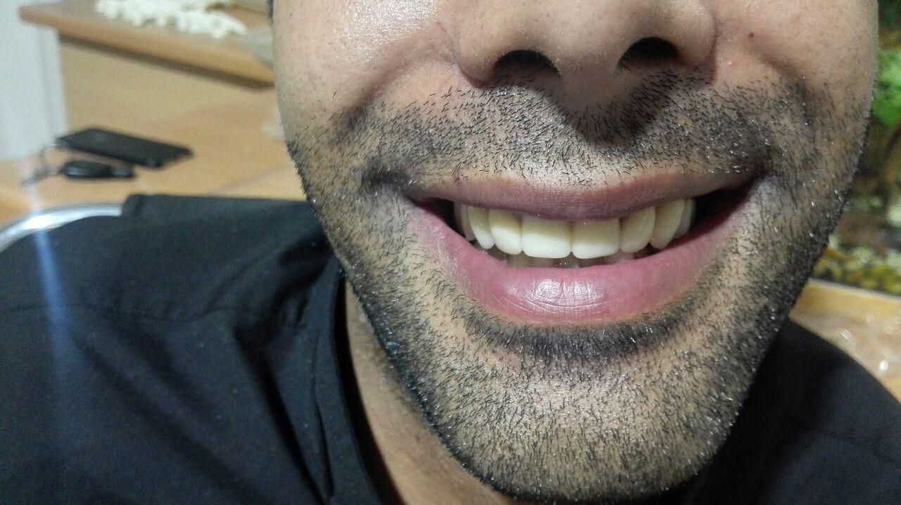 دندان مصنوعی (دست دندان)|آرایشی، بهداشتی، درمانی|تهران, صفا|دیوار