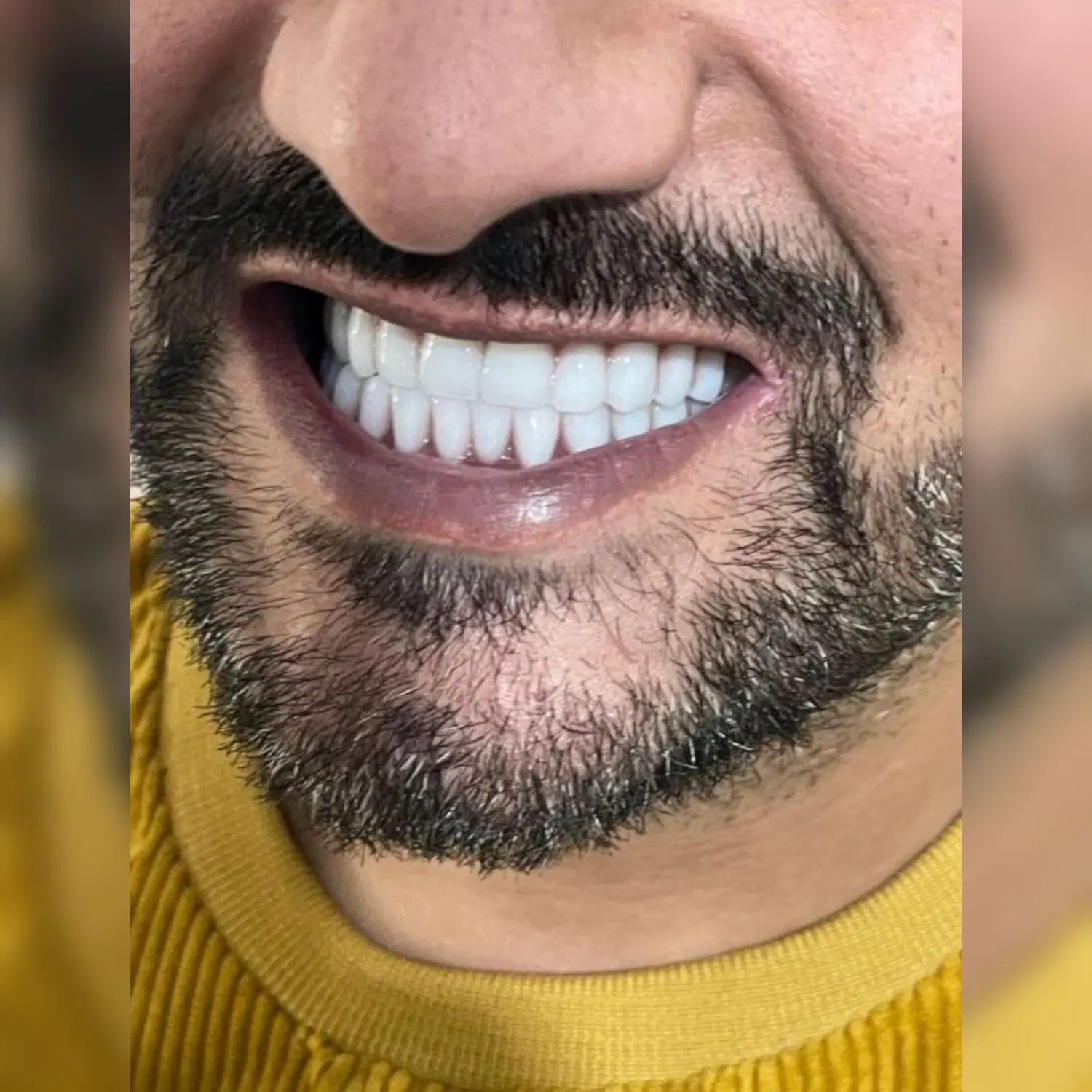 دندانسازی دندانپزشکی ایمپلنت کامپوزیت پروتز ثابت|خدمات آرایشگری و زیبایی|مشهد, پنجتن|دیوار