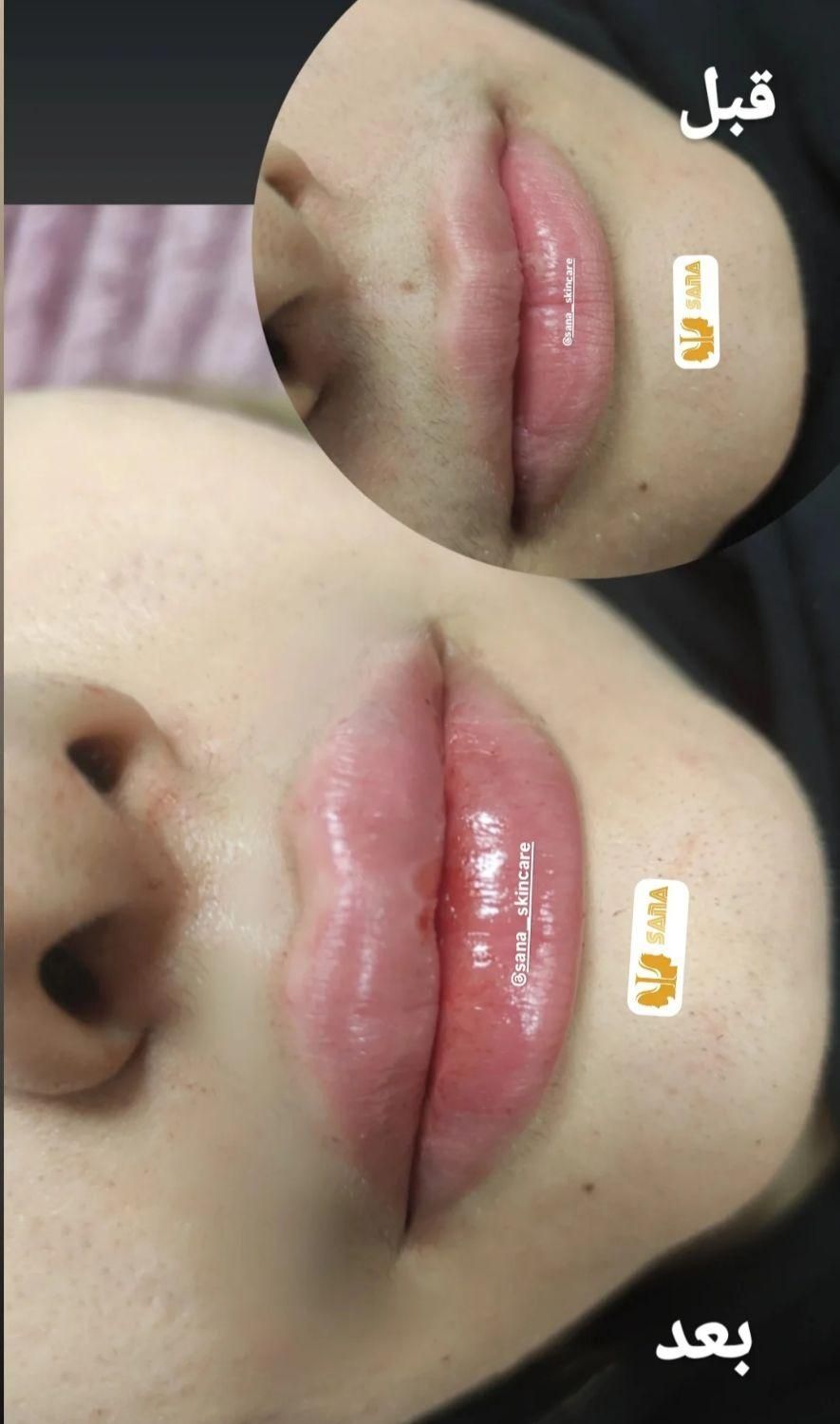 تزریق ژل و بوتاکس|خدمات آرایشگری و زیبایی|اهواز, نادری|دیوار