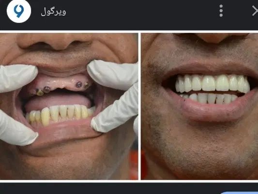 ایمپیلنت تخصصی کلینیک دندانپزشکی آرمی|خدمات آرایشگری و زیبایی|تهران, شکوفه (عبدل آباد)|دیوار