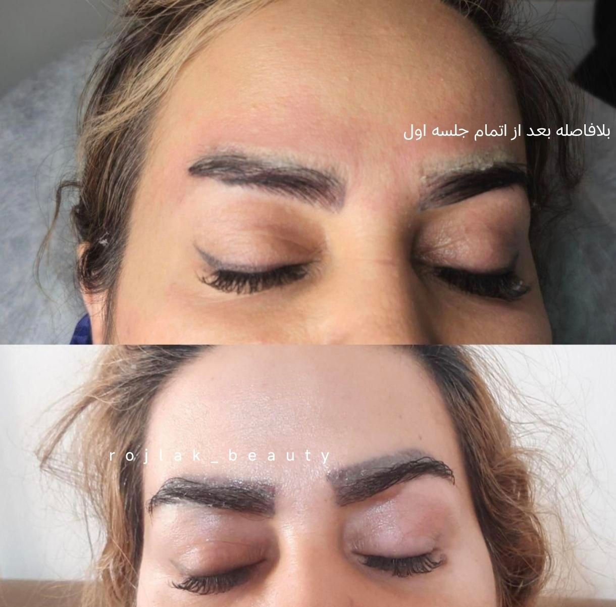 پاک کردن تتو و خالکوبی با لیزر کیوسوییچ پیکوشور|خدمات آرایشگری و زیبایی|مشهد, فرودگاه|دیوار